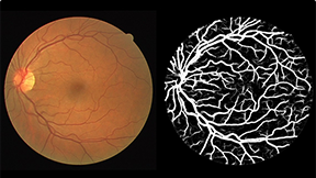 眼底视网膜血管图像分割